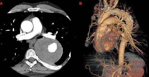 Figure 2 Postoperative CT-scan at 3-year follow-up. (A) axial view showing lumen and thrombosed aneurysm sac, (B) 3-dimensional aorta.