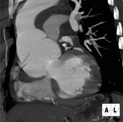 Figure 3 Patient presenting with acute chest pain; CCTA image showing large aortic root dissection.