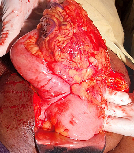 Figure 4 A mass formed by the omentum, mid-ileum, and descending and sigmoid colons.