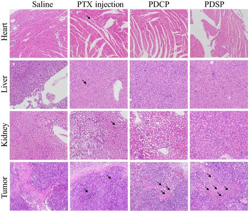 Figure 6 The images of the heart, liver, kidney, and tumor slices stained with H&E dyes after treatment by the different Paclitaxel (PTX) formulations, such as PTX injection, mPEG-DCA-CC-PTX (PDCP) and mPEG-DCA-SS-PTX (PDSP). Black arrows indicate tissue injury in this area, such as cell degeneration, necrosis, inflammatory cell infiltration and intra-tissue bleeding.