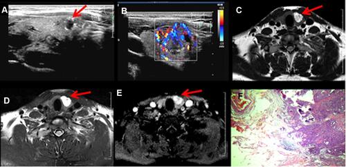 Figure 1 Images from a representative PTC patient with minimal ETE in the left thyroid lobe (male, 24 years old). (A) Transverse view of US image shows the lesion locally protruded thyroid capsule (red arrow), (B) Doppler shows abundant blood flow signals in the peripheral and internal areas, (C) T2WI image, (D) fat-saturated T2WI image, (E) contrast-enhanced T1WI image shows the lesion the locally protruded thyroid capsule (arrow), and (F) histopathological H&E (total magnification, 10×) image of a PTC showing minimal ETE (extension to sternothyroid muscle).