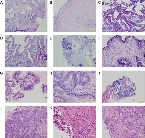 Figure 1 Sections of esophageal epithelium from matched research and clinical biopsies from the esophagus. Research biopsy sections are shown on the left panel and the matched clinical biopsy sections are on the right panel. A–F are sections stained with ABPAS/D. G–L are sections stained with H&E. A and B show stratified squamous epithelium, C and D show columnar lined epithelium without intestinal metaplasia, E and F show columnar-lined epithelium with intestinal metaplasia, G and H show changes consistent with low grade dysplasia, I and J represent carcinoma in-situ, and K and L show invasive cancer.