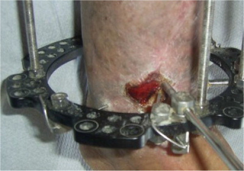 Fig. 6 Clinical picture showing the Ilizarov external fixation combined with Papineau technique.