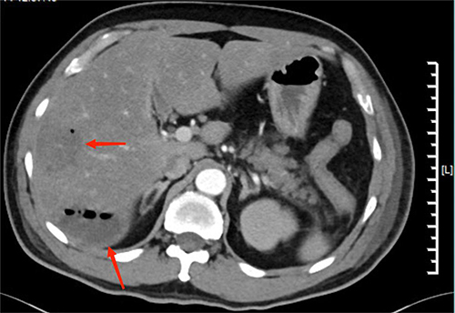 Figure 3 Computer tomography of the abdomen. Two areas of the right hepatic lobe have liver abscesses and both contain air (marked by red arrows).