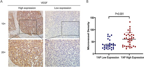 Figure 3. MVD and VEGF expression in hepatoblastoma. (A) Immunohistochemistry for VEGF in hepatoblastoma tissues (x100 and x200). (B) YAP high expression cases exhibited higher MVD (60.72 ± 28.22) than YAP low expression cases (37.71 ± 18.54) (P = 0.001).