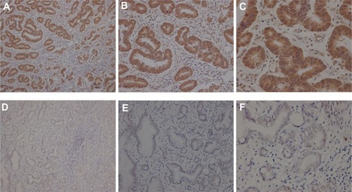 Figure 1 Lin28 Immunohistochemical staining of gastroscope tissues in gastric patients (A–C) Lin28 expression are strong positive in representative slide (A, B, C is separately shown at 100×, 200×, 400× magnification). (D–F) Lin28 expression are almost negative in representative slide (D, E, F is separately shown at 100×, 200×, 400× magnification).