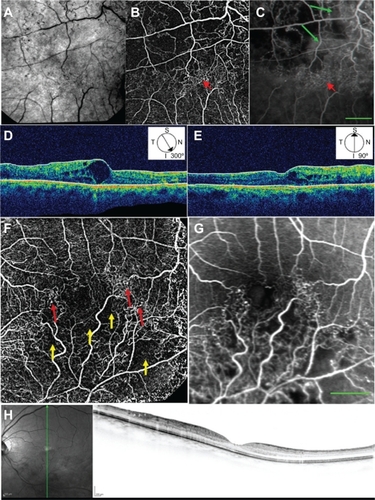Figure 4 Red-free, nCPM, FA, and OCT images from two patients with BRVO. (A) Red-free image from a 57-year-old male suffering from BRVO with macular edema in the right eye. (B) Corresponding nCPM image (nine series combined into one). (C) Corresponding FA image; green arrows show examples of leaks. The nCPM shows fine vascular detail not visible on the regular red-free image. Macular vascular networks of pathological collateral and connecting channels (red arrows) are shown in detail in the nCPM. (D, E) Corresponding OCT images displaying cystoid macular edema in the region of the abnormal vasculature. (F) nCPM image (nine series combined into one) from a 63-year-old female suffering from BRVO with macular edema in the left eye. (G) Corresponding FA image. The nCPM image demonstrates both nonperfusion (yellow arrows) and detailed neovascularization (red arrows), which correspond with the FA image. (H) Corresponding OCT images displaying edema in the region of the abnormal vasculature.