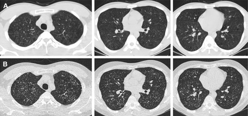 Figure 4 A 26-year-old male ex-smoker with pathologically diagnosed RB.