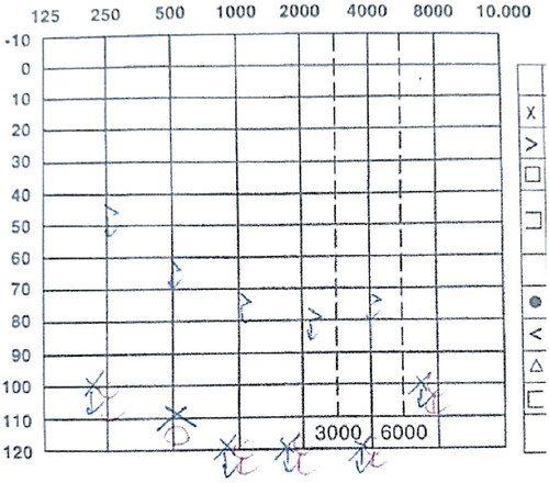 Figure 1. Pre-operative audiogram of the patient showed the bilateral profound hearing loss with Pure Tone Average (PTA) > 90 dB.
