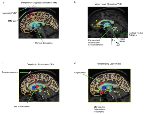 Figure 1 Illustration of brain regions affected by the physical treatments transcranial magnetic stimulation (a), vagus nerve stimulation (b), deep brain stimulation (c), and neurosurgery (d).