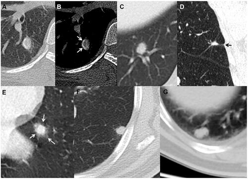 Figure 6 Tuberculous nodules with smooth margin (A) and curved calcification (arrows) (B), coarse margin (C), sparse and long spiculations and pleural indentation (arrow) (D), and ill-defined peripheral patch (arrows) (E). A cryptococcal nodule abutting pleura with a wide base (F), and an oval aspergillus nodule with clear and smooth margin (G).