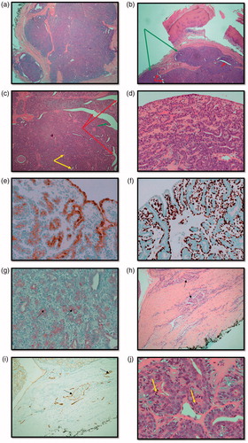 Figure 3. (a) Haemotoxylin and Eosin (H&E) stained section showing an overview of the multinodular, circumscribed and predominantly solid tumour (x2). (b) H&E stained section demonstrating multinodular tumour (green arrows) that is largely solid but with and ductal/tubular structures (red arrows) (x2). (c) H&E section demonstrating cystic spaces (red arrows) with papillary projections (green arrows) and tubules (yellow arrows) (x4). (d) H&E section showing double epithelial layer (x20). (e) Epithelial membrane Antigen (EMA) stain positivity. Expressed by ductal epithelial cells (x20). (f) p63 myoepithelial marker stains positive (x20). (g) S-100 stains weakly positive (black arrows) (x20). (h) H&E stained section demonstrating lymphovascular invasion (LVI) (black arrows) (x10). (i) D2-40 (podoplanin) stained section demonstrates lymphatic endothelium (black arrows) supporting the evidence for LVI (x10). (j) Mitotic figures indicated by yellow arrows (x40).