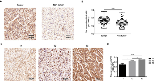 Figure 3 Expression of hnRNPA1 in human hepatocellular carcinoma. (A). Representative IHC staining results of hnRNPA1 in liver cancer tissues and non-tumor tissues (scale bar = 50 μm). (B). Statistical analysis of the mean density (IOD/area) of hnRNPA1 in the corresponding tissues. Results are presented as mean ± SD from 75 pairs of samples. ****P < 0.0001. (C). Representative IHC staining results of hnRNPA1 in T1-T3 stage (scale bar = 50 μm). (D). Statistical analysis of the mean density (IOD/area) of hnRNPA1 in the corresponding T stage. Data are expressed as the means ± SD, *P < 0.05, **P < 0.01 and ****P < 0.0001.