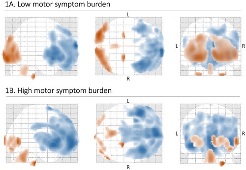 Figure 1 (A–B) General pattern of brain metabolic alterations on FDG-PET imaging in ALS. Distribution of brain metabolic alterations in 66 ALS patients with a low motor symptom burden (A) and 65 ALS patients with a high motor symptom burden (B), compared to a cohort of 39 healthy controls. Blue indicates areas of relative hypometabolism, and orange indicates areas of relative hypermetabolism (difference only appreciable in color version). FDG-PET: fluorodeoxyglucose-positron emission tomography; L: left; R: right.