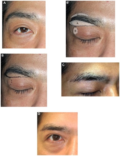 Figure 4 Case 1. (A) A 50-year-old man with moderate bilateral dermatochalasis. (B) Extended IBEB with FUT was carried out. The maximum width of the skin pad was 17 mm. The subseptal fat was dissected. The incision was made perpendicularly to the hair shafts. The numbers of follicular units available to transplant were 100 on each side, and these were transplanted in the upper part of the eyebrow from body to tail. (B′) The portion of excised the eyebrow, is area A. Approximately half of the eyebrow was excised from the body to the tail of the eyebrow. The portion of removed orbital fat is area B. The portion of transplanted hair to the eyebrow is area C. It extended from the center of the eyebrow to the outside of the eyebrow’s superior border with a maximum width of 7 mm. (C) Twelve months after the operation, the scar had become less conspicuous. The scar just along the lower margin of the eyebrow was partially covered by regrown hair. The transplanted hair was growing. (D) Twenty-four months after the operation, the regrown eyebrow entirely covered the scar and made it inconspicuous. The transplanted hair was also fully grown. Any changes in, reduction, or distortion of the eyebrow were acceptable. The patient was satisfied with the result and no complications were observed. He opened his eyes more easily, his visual field had become larger, and his lid creases had a more youthful appearance.