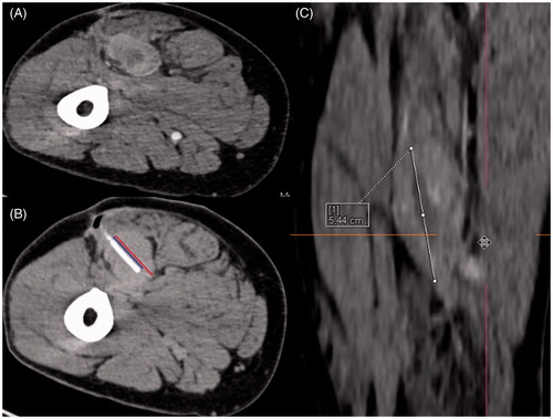 Figure 1. Illustration of our calculated ratios through the example of a 54-year old man with an undifferentiated sarcoma in the right upper leg. (A) Contrast-enhanced planning CT scan in prone position clearly demarcates the vascularised tumour from the surrounding muscles. (B) Ratio 1 describes the proportion of the intratumoural catheter length (blue line) compared to the maximum tumour diameter in continuation of the catheter position (red line). In this example ratio 1 = 2.23:2.96 cm = 0.75. (C) Ratio 2 describes the proportion of the intratumoural catheter length (blue line in B) compared to the maximum total tumour diameter in any plane. In this example we reconstructed the coronary image via syngo.via® software (Siemens) because the maximum tumour extent is in this plane (white line). Here ratio 2 = 2.23:5.44 cm = 0.41.