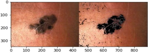Figure 4. Clinical image of melanoma before (left) and after (right) the preprocessing stage.