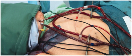 Figure 2. Catheters in place with extracorporeal circuit connected during a femoral MI-ILP.