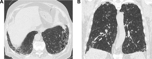 Figure 2 A 57-year-old former male smoker with clinical chronic obstructive lung disease (COPD).Notes: (A) Both study observers jointly considered the thick-walled low attenuation areas in the lower lobes as consistent with reticular opacities superimposed to pulmonary emphysema (ie, not as honeycombing). (B) The latter was also abundant in the upper middle lung regions. The LDCT pattern was indeed rated as possible UIP.Abbreviations: LDCT, low-dose computed tomography; UIP, usual interstitial pneumonia.