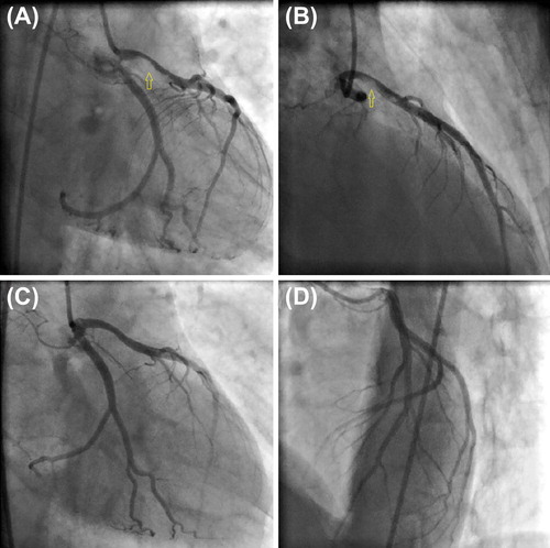 Fig. 2. (A and B) Selective left coronary angiogram showing severe thrombotic stenosis at the proximal portion of the left anterior descending artery (yellow arrows). (C and D) Selective left coronary angiogram obtained 3 days after intravenous Tirofiban infusion showing patent left anterior descending artery without residual stenosis.