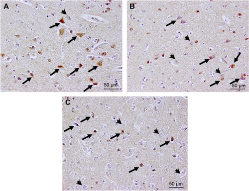 Figure 2 CaN-IR neurons in brain sections from controls, patients with schizophrenia, and a patient with both schizophrenia and acute myelomonocytic leukemia treated with tacrolimus.