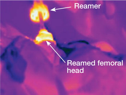 Infra-red thermal image of crown reamer and remaining femoral head during peripheral reaming.