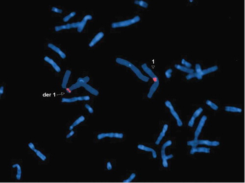 Figure 5. Metaphase FISH showing: der(1) with a positive signal for the 1 centromere (red); 1 with a positive signal for the 1 centromere (red). DNA is stained blue with DAPI