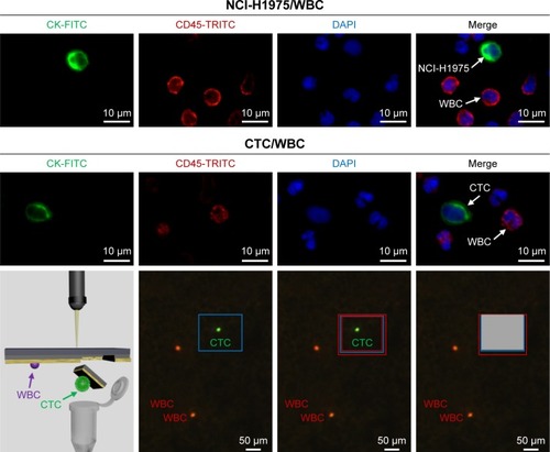 Figure 3 Identification of CTC, based on a three-color immunostaining using FITC-conjugated anti-CK, TRICT-conjugated anti-CD45 (a marker of WBC) and DAPI (nuclear specific).Notes: NCl-H1975 cells spiked in normal blood were used as a positive control. Isolating a single CTC was performed through laser microdissection after confirming the location by immunostaining.Abbreviations: CTC, circulating tumor cell; DAPI, 4,6-diamino-l2-phenyl indole; FITC, fluorescein isothiocyanate; TRICT, tetramethylrhodamine; WBC, white blood cell.