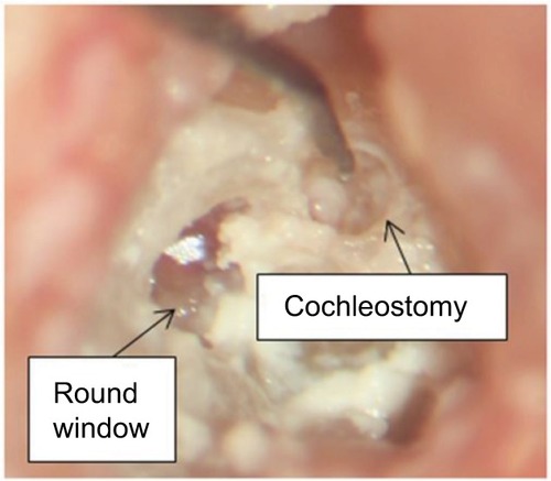 Figure 5 The finished cochleostomy using both hand-guided robotic drill and conventional surgical drill with endosteal membrane.