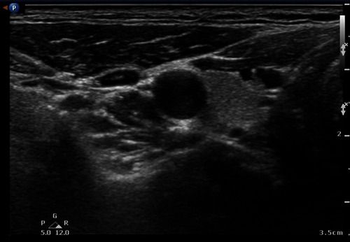 Figure 6 Photograph during the infraorbital nerve block procedure.