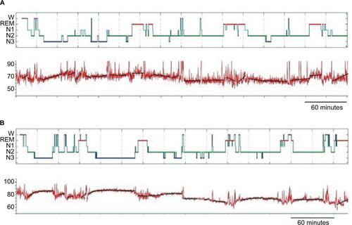 Figure S1 Examples of HR slope assessments from clinical PSGs.Notes: In (A) and (B), the scored hypnogram is shown above the HR tracing derived from the pulse oximetry signal as visualized through the Grass software. The HR units (Y-axis) are in beats per minute. The color scheme of the stages is the same as in Figure 1 of the main text. Stages are indicated on the Y-axis. Time base is given for an 1 hour increment (and hash marks on the X-axis are 30 minutes apart). For each sleep–wake stage bout of 35 minutes (“stable” bouts), the calculated best fit line is super-imposed on the HR trace (black lines).Abbreviations: HR, heart rate; PSGs, polysomnography; REM, rapid eye movement; W, wake.