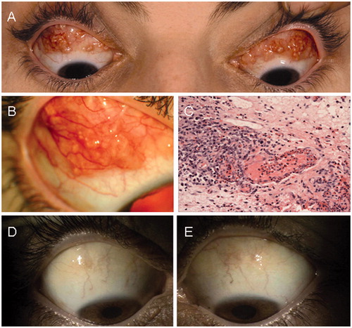 Figure 1. (A) The patient at presentation with bilateral multinodular involvement of the bulbar conjunctiva. (B) The appearance of the nodules on closer examination. (C) Conjunctival stroma with mixed inflammatory infiltrate and numerous eosinophils within a vessel wall (×20 objective, hematoxylin & eosin stain). (D, E) Resolution of the multinodular masses of the conjunctiva on the right and left, respectively.