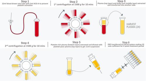 Figure 1 PRP was prepared using a 2-step centrifugation method.Citation18,Citation22 Step 1: 22 mL of blood was drawn into tubes containing 2mL of acid-citrate-dextrose solution A. Step 2: The citrated blood was centrifuged at 1500g for 10 minutes. Step 3: The plasma layer (top) and buffy coat layer (middle) containing platelets were extracted. Step 4: Both layers were centrifuged again at 1500g for 10 minutes. Step 5: The entire platelet-rich pellet (bottom layer) was extracted and resuspended with some platelet-poor plasma (top layer) to create an 11mL PRP suspension. Step 6: PRP suspension was aliquoted into vials for storage.