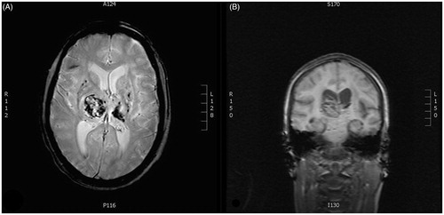 Figure 2. Magnetic resonance images of the cerebrum of the patient after admission to the neurological department. The images reveal acute intracerebral hemorrhage in the right thalamic region as well as several microbleeds. A: Transverse plane. B: Coronal plane.