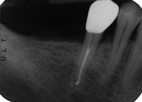 Figure 12 Periapical radiography, the monolithic zirconia crown has been luted definitively.