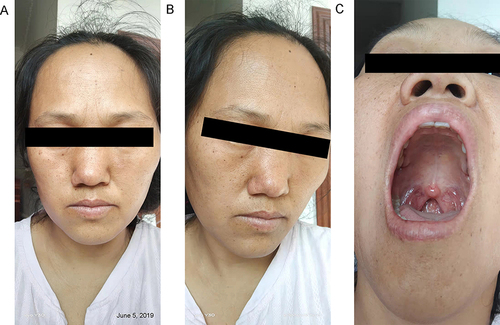 Figure 4 (A–C) Erythematous, infiltrating plaques changes had cleared completely.