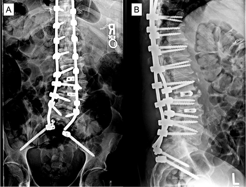 Figure 1 Patient underwent T10-ilium PSIF. Two weeks postoperatively, he experienced acute onset of low back pain while getting up from chair. (A) PA and (B) lateral x-rays showed pullout of right rod from S2AI screw and set screw popped off from R S2AI screw. Of note, S1 screws are missing, which may have led to the acute iliac screw failure.