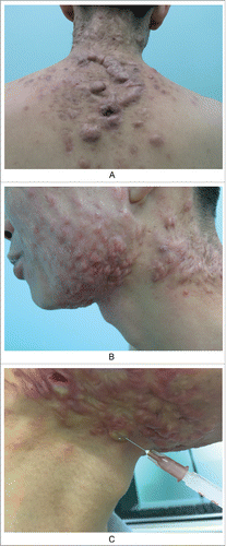 Figure 3. Keloids secondary to severe acne. A. Obvious cord-like hyperplasia on the back; B. Nodules and cysts on the submandibular neck, old scars/keloids on the neck and neck side; C. The contents of sebaceous glands were squeezed out due to the high injection pressure, when we injected the hormone into scar nodules.