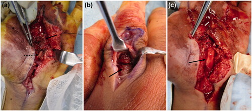 Figure 3. (a) Paint is observed inside the carpal tunnel (arrow: paint, dashed arrow: median nerve). (b) There is also paint on the dorsal side of the proximal phalanx (arrow). (c) After removing paint, the median nerve is evaluated (arrow: median nerve).