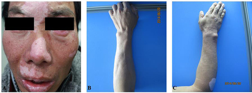 Figure 5 Patient No.4 (A) Image of white spot on the face of the patient (B) Image of right upper limb of the patient (C) Image of left upper limb of the patient.