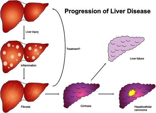 Figure 1 Natural progression of liver disease. Liver insult of any etiology results in inflammatory changes in hepatic parenchyma which progress to fibrosis and ultimately cirrhosis if unaddressed. Cirrhosis culminates in liver failure and is a principal risk factor for hepatocellular carcinoma.