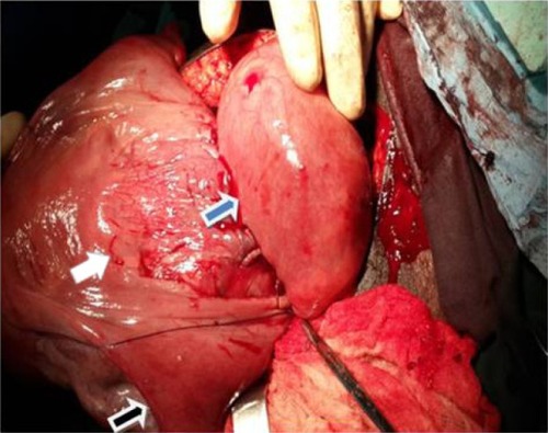 Figure 3 Repaired uterus and posterior urinary bladder wall.