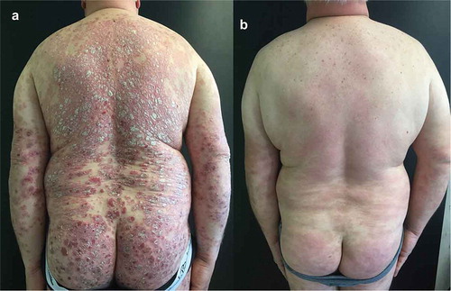 Figure 2. Representative images of outcome at the back and gluteal region in Patient #1. A male patient, aged 50 years with onset of psoriasis at 38 years of age and BMI of 25.1 At baseline, PASI was 48 (A). After 4 and 24 weeks with brodalumab, PASI decreased to 15 and 8 respectively (B)