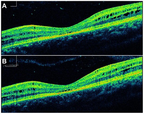 Figure 4 Spectral domain optical coherence tomography analysis of the left eye of Case 2. The right eye demonstrated similar findings as the right eye of Case 1 (not shown). Horizontal cuts through the left eye taken above (A) and below (B) the fovea demonstrated multiple small cystic spaces in multiple retinal layers without disruption of the overall structure of the retina.