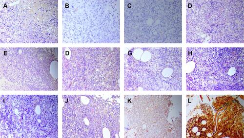 Figure 8 The immunostaining of bone marrow after two courses of chemotherapy. (A) (b-FGF;×200), negative; (B) (CD19;×200), negative; (C) (CD117;×200), negative; (D) (IL-1β;×200), negative; (E) (IL-2;×100), negative; (F) (IL-6;×200), negative; (G) (IL-10;×200), negative; (H) (PDGF×200), negative; (I) (TGF-β×200), negative; (J) (TNF-α×200), negative; (K) (VEGF×100), positive; (L) reticular fiber staining 100×, MF 0–1.