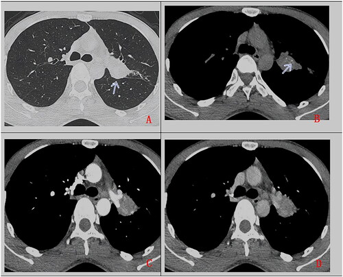 Figure 3. A 27-year-old man, with cough for more than 2 months. Chest CT scan without contrast (A. lung window, B. mediastinum window) and with contrast (C. artery phase, D. delayed phase). Soft tissue mass in left upper hilum (as indicated by arrow), with lobulated margin, heterogeneous density, punctuate calcification (as indicated by arrow), uneven enhancement, accompanied by adjacent bronchus obstruction. Pathologically confirmed PMEC after surgical operation.
