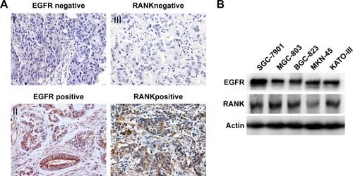 Figure 1 The expression of RANKL in GC tissues.