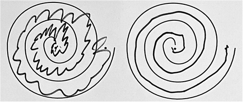 Figure 1 Stereotactic radiofrequency ablation thalamotomy for tremor. Hand drawn spiral before (left) and after (right).