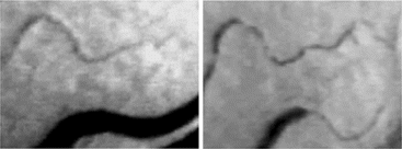 Figure 7 A series of two images showing the same location in the conjunctival microcirculation of a dog during post-hemorrhagic and post-resuscitation phases of the experiment in the vasopressin study. Again, the same vessels were identified and relocated for longitudinal evaluations. Note the extensive vasoconstriction arising from the vasopressin infusion. Magnification = 125 × on-screen.
