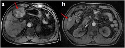 Figure 3. Post-ablation imaging: after the ablation was completed, the ablation lesion displayed a ‘target sign’ in the LAVA-Flex sequence (a,b). the scanning equipment was Ge MR750W with the following parameters: FOV = 40 cm, phase FOV = 0.8, and layer thickness 5.0 mm. Matrix = 256 * 192, NEX = 1, bandwidth = 142.8, flip angle = 15.